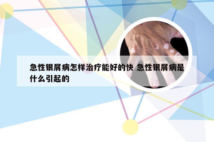 急性银屑病怎样治疗能好的快 急性银屑病是什么引起的