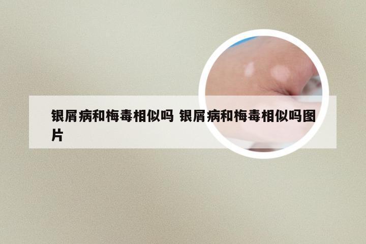 银屑病和梅毒相似吗 银屑病和梅毒相似吗图片