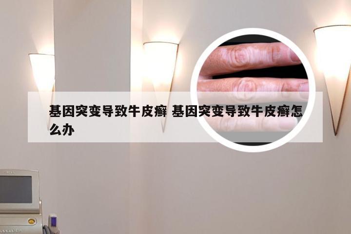 基因突变导致牛皮癣 基因突变导致牛皮癣怎么办