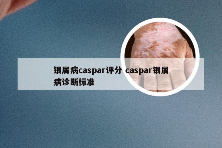 银屑病caspar评分 caspar银屑病诊断标准