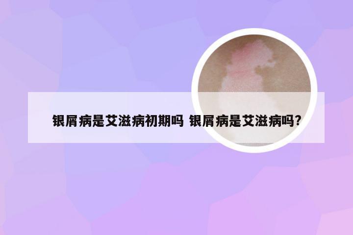 银屑病是艾滋病初期吗 银屑病是艾滋病吗?