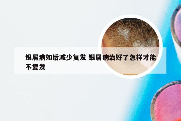 银屑病如后减少复发 银屑病治好了怎样才能不复发