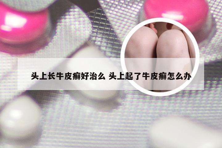 头上长牛皮癣好治么 头上起了牛皮癣怎么办