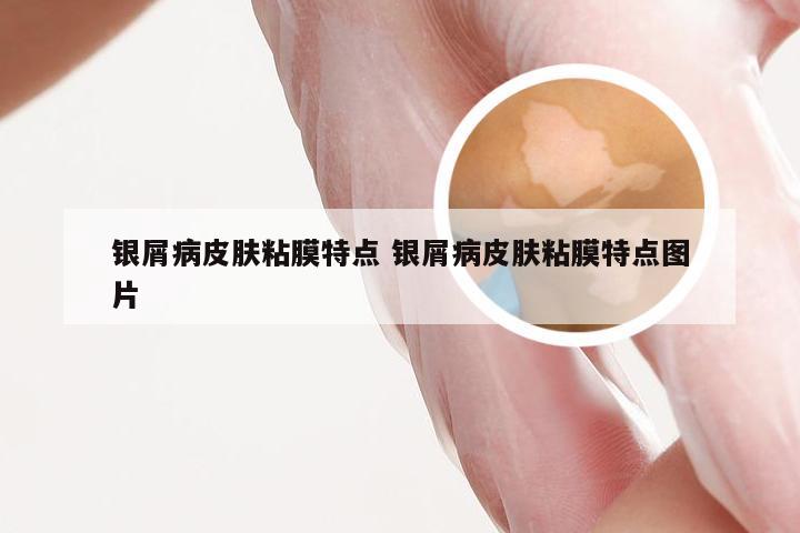 银屑病皮肤粘膜特点 银屑病皮肤粘膜特点图片