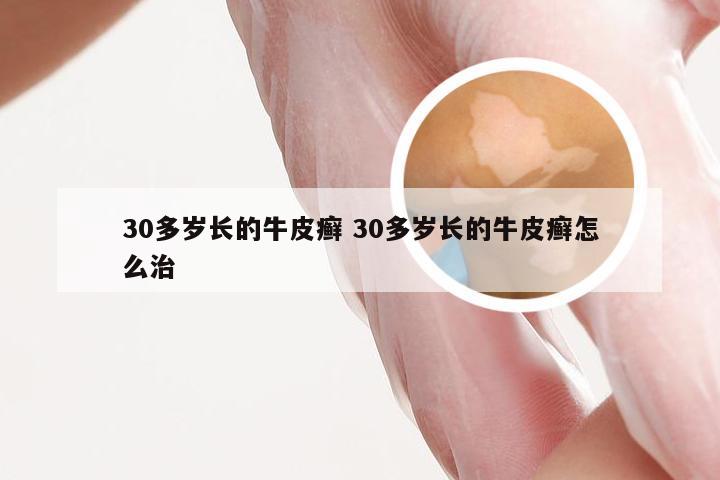 30多岁长的牛皮癣 30多岁长的牛皮癣怎么治