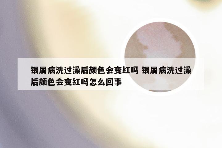 银屑病洗过澡后颜色会变红吗 银屑病洗过澡后颜色会变红吗怎么回事