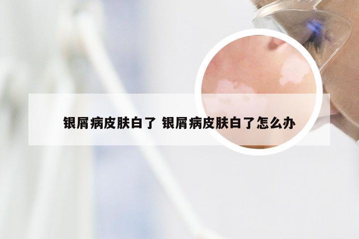 银屑病皮肤白了 银屑病皮肤白了怎么办