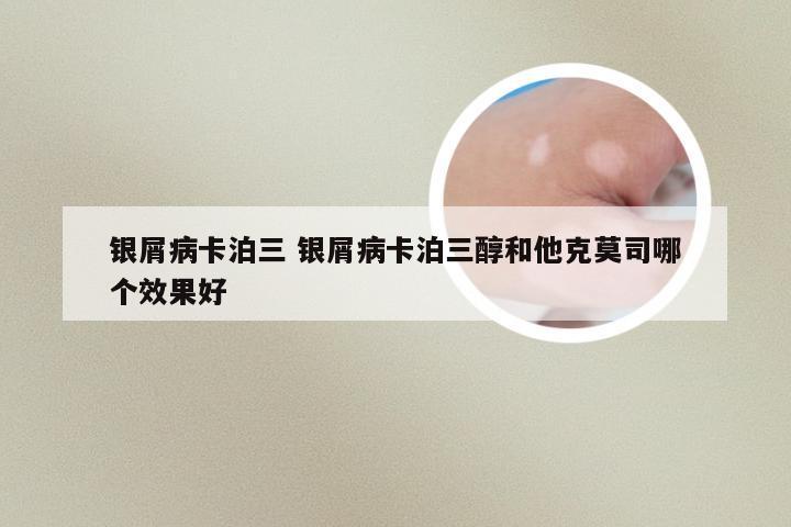银屑病卡泊三 银屑病卡泊三醇和他克莫司哪个效果好