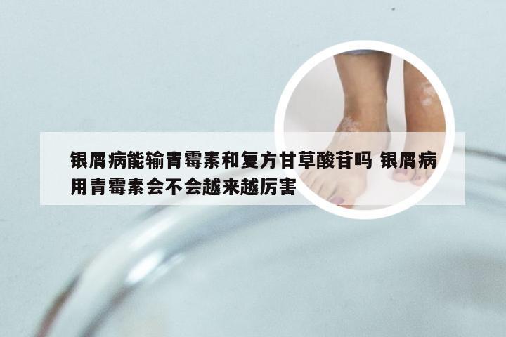 银屑病能输青霉素和复方甘草酸苷吗 银屑病用青霉素会不会越来越厉害