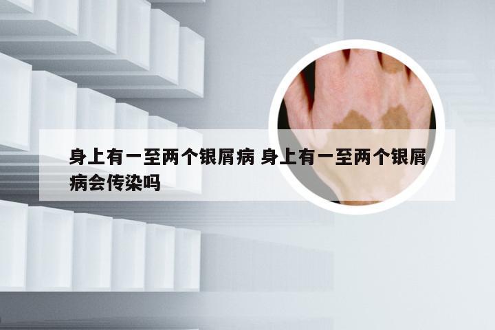身上有一至两个银屑病 身上有一至两个银屑病会传染吗