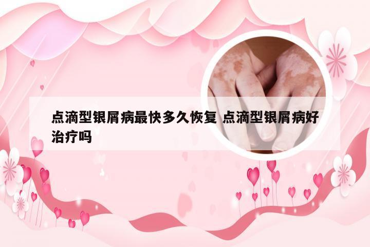 点滴型银屑病最快多久恢复 点滴型银屑病好治疗吗