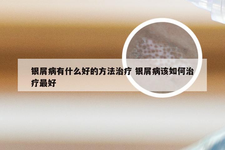 银屑病有什么好的方法治疗 银屑病该如何治疗最好