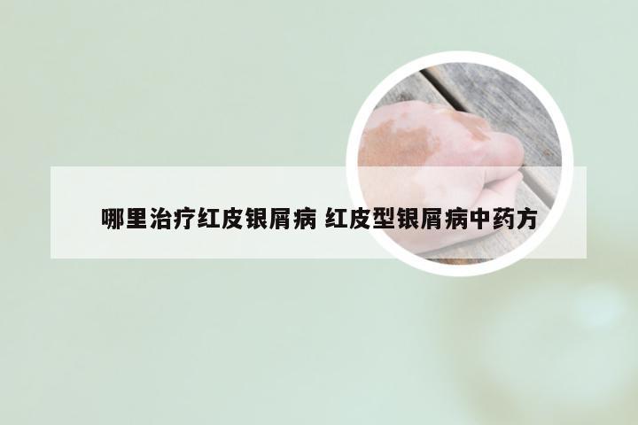 哪里治疗红皮银屑病 红皮型银屑病中药方