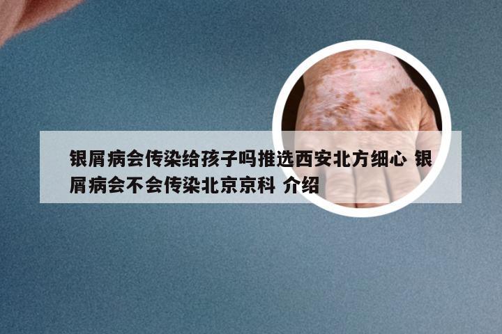 银屑病会传染给孩子吗推选西安北方细心 银屑病会不会传染北京京科 介绍