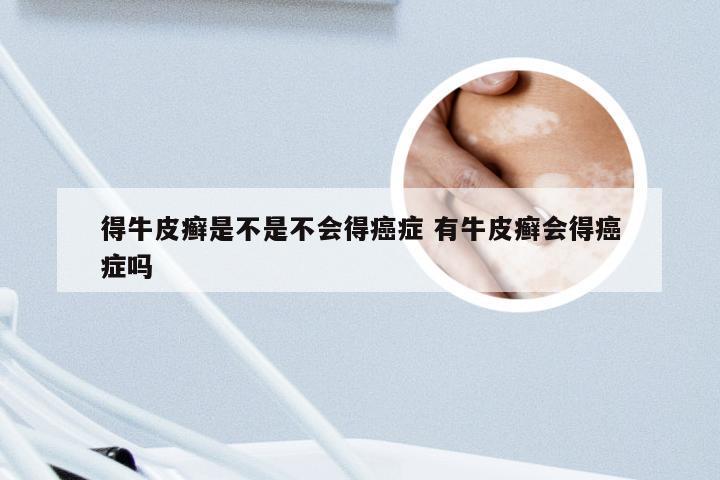得牛皮癣是不是不会得癌症 有牛皮癣会得癌症吗