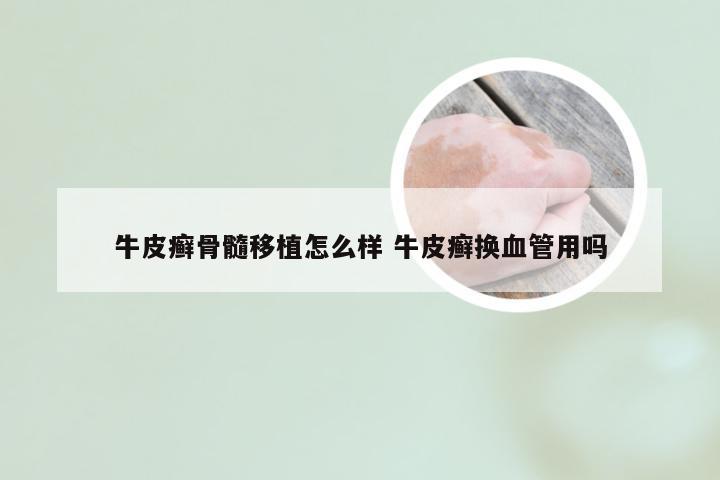 牛皮癣骨髓移植怎么样 牛皮癣换血管用吗