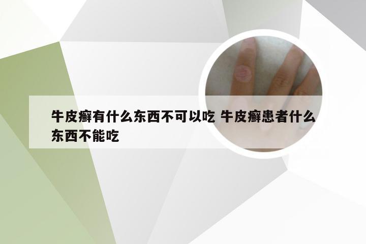 牛皮癣有什么东西不可以吃 牛皮癣患者什么东西不能吃