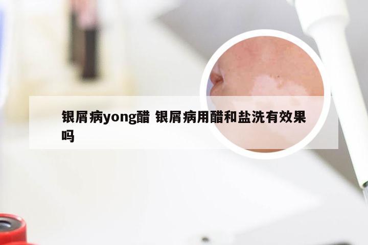 银屑病yong醋 银屑病用醋和盐洗有效果吗