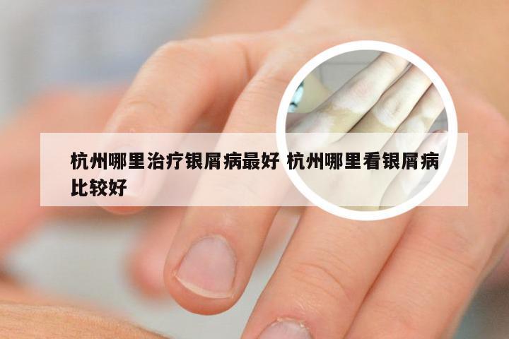 杭州哪里治疗银屑病最好 杭州哪里看银屑病比较好