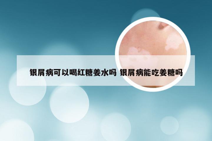 银屑病可以喝红糖姜水吗 银屑病能吃姜糖吗