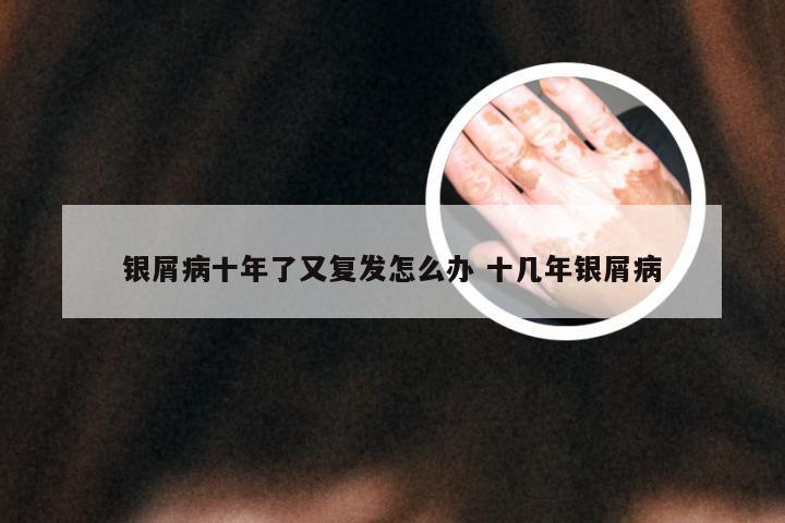 银屑病十年了又复发怎么办 十几年银屑病