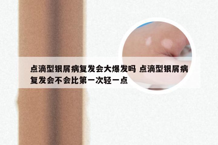 点滴型银屑病复发会大爆发吗 点滴型银屑病复发会不会比第一次轻一点