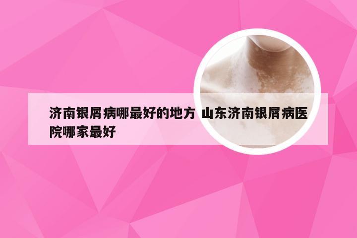 济南银屑病哪最好的地方 山东济南银屑病医院哪家最好