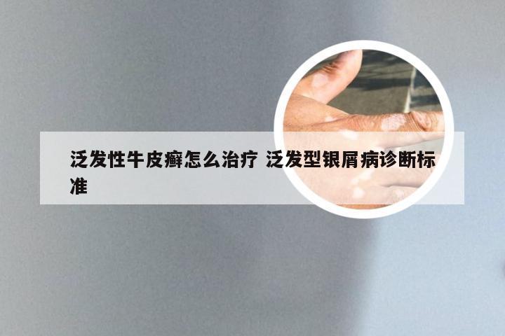 泛发性牛皮癣怎么治疗 泛发型银屑病诊断标准