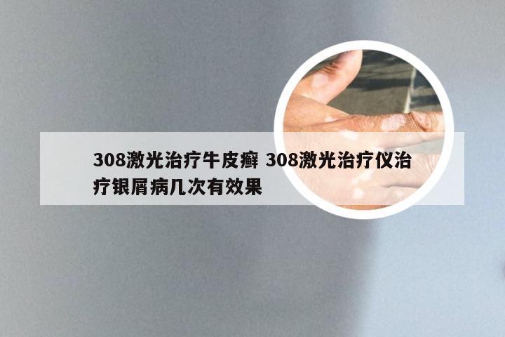 308激光治疗牛皮癣 308激光治疗仪治疗银屑病几次有效果