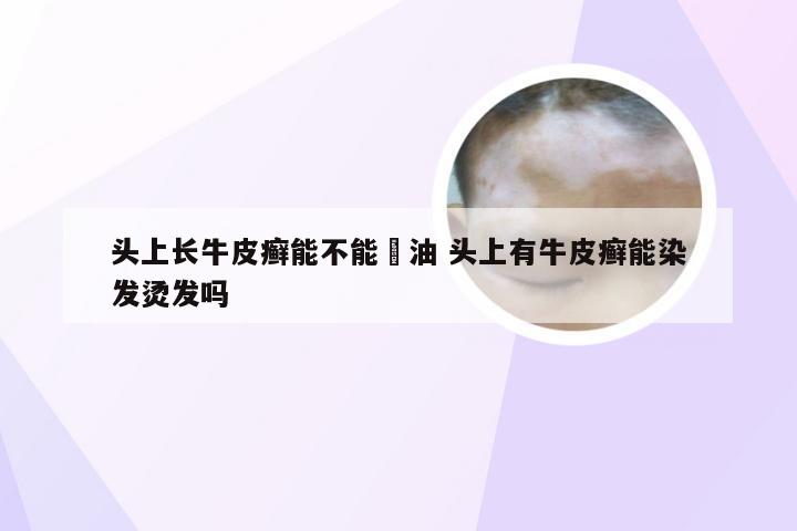 头上长牛皮癣能不能焗油 头上有牛皮癣能染发烫发吗