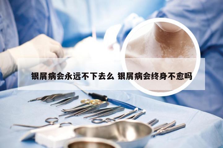 银屑病会永远不下去么 银屑病会终身不愈吗