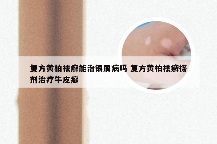复方黄柏祛癣能治银屑病吗 复方黄柏祛癣搽剂治疗牛皮癣