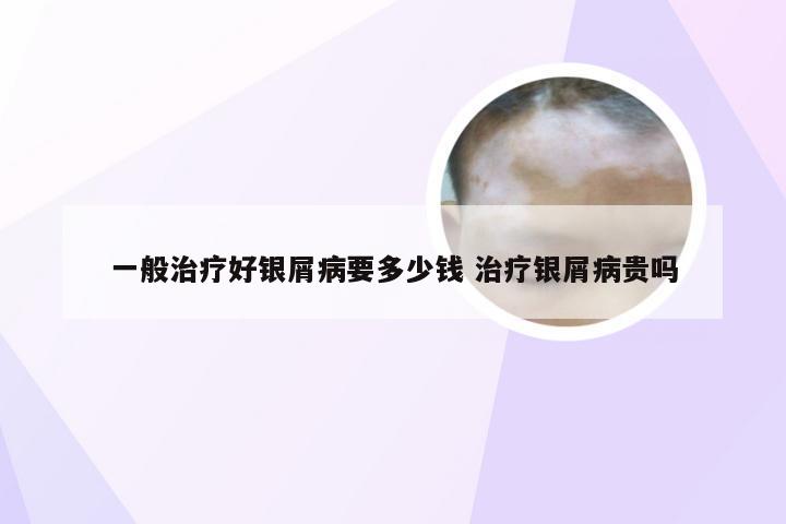 一般治疗好银屑病要多少钱 治疗银屑病贵吗