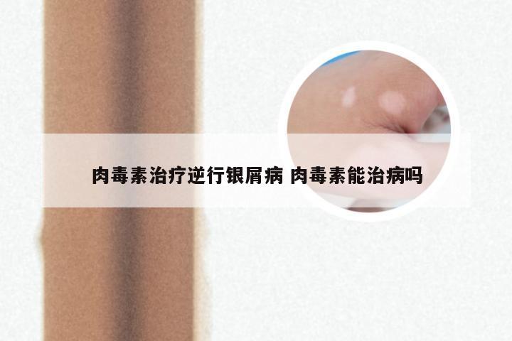 肉毒素治疗逆行银屑病 肉毒素能治病吗