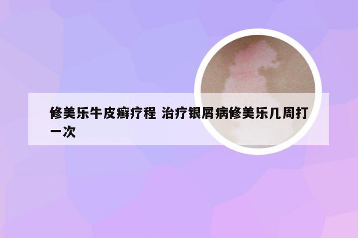修美乐牛皮癣疗程 治疗银屑病修美乐几周打一次