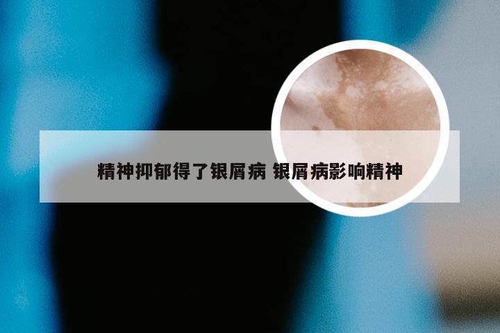 精神抑郁得了银屑病 银屑病影响精神