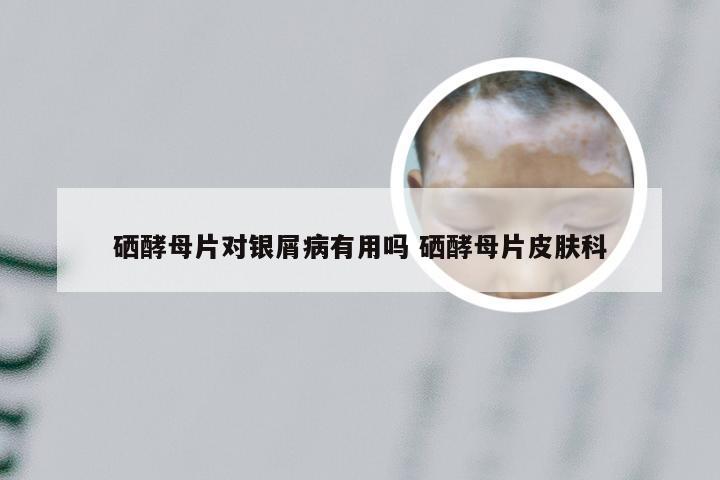硒酵母片对银屑病有用吗 硒酵母片皮肤科