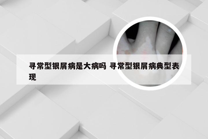 寻常型银屑病是大病吗 寻常型银屑病典型表现
