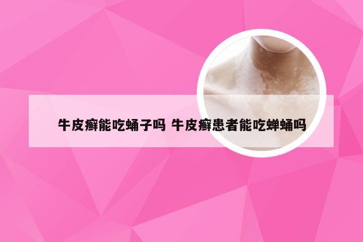 牛皮癣能吃蛹子吗 牛皮癣患者能吃蝉蛹吗