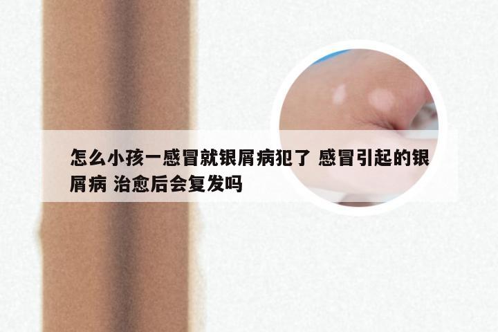 怎么小孩一感冒就银屑病犯了 感冒引起的银屑病 治愈后会复发吗