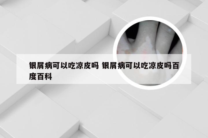银屑病可以吃凉皮吗 银屑病可以吃凉皮吗百度百科