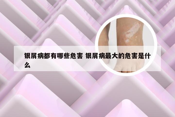 银屑病都有哪些危害 银屑病最大的危害是什么