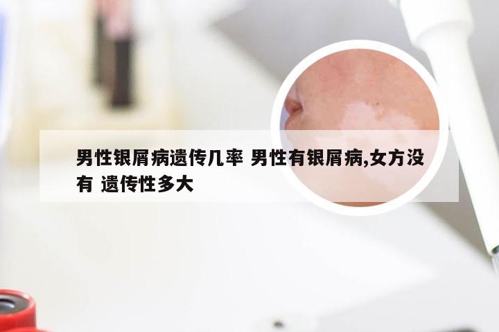 男性银屑病遗传几率 男性有银屑病,女方没有 遗传性多大