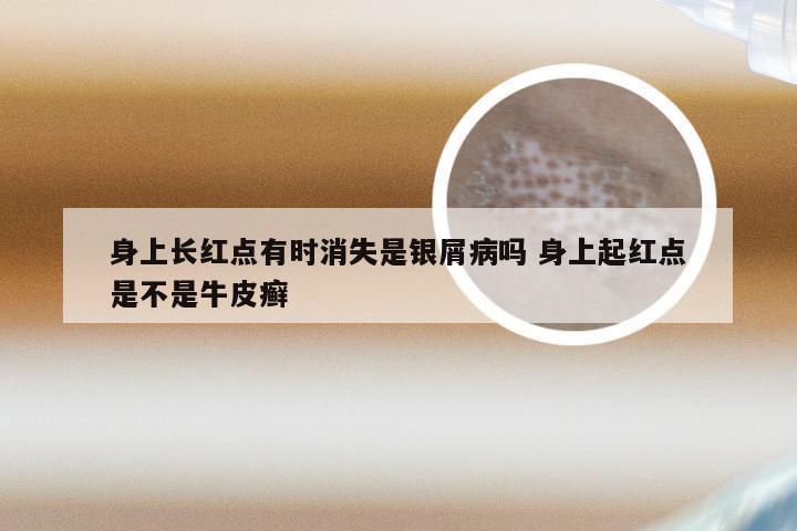 身上长红点有时消失是银屑病吗 身上起红点是不是牛皮癣