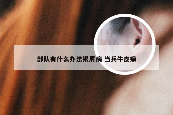 部队有什么办法银屑病 当兵牛皮癣