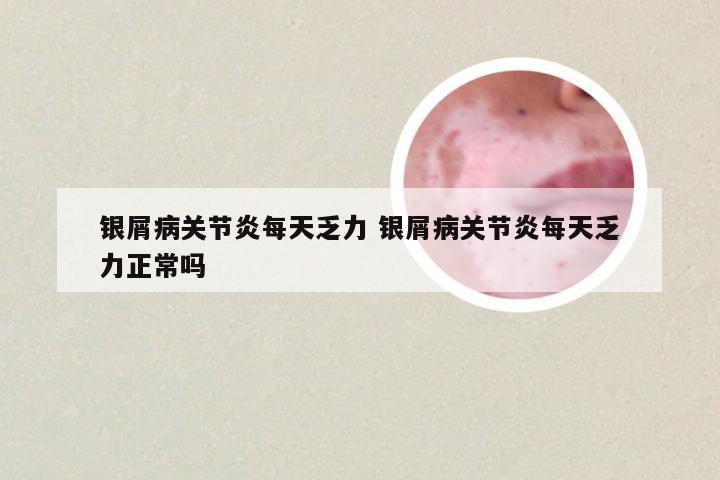 银屑病关节炎每天乏力 银屑病关节炎每天乏力正常吗