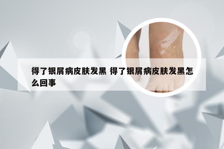 得了银屑病皮肤发黑 得了银屑病皮肤发黑怎么回事