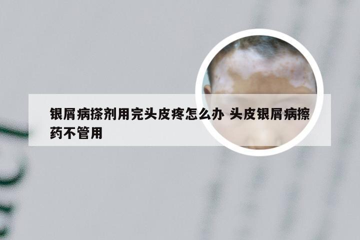银屑病搽剂用完头皮疼怎么办 头皮银屑病擦药不管用