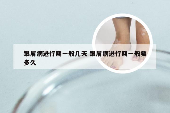 银屑病进行期一般几天 银屑病进行期一般要多久