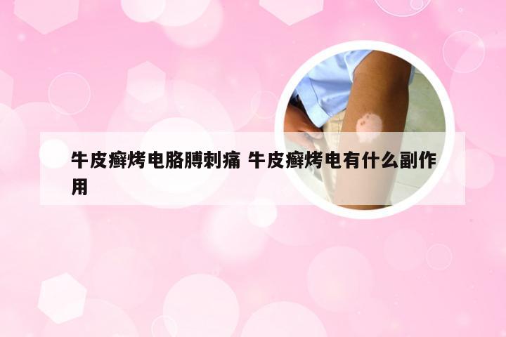 牛皮癣烤电胳膊刺痛 牛皮癣烤电有什么副作用